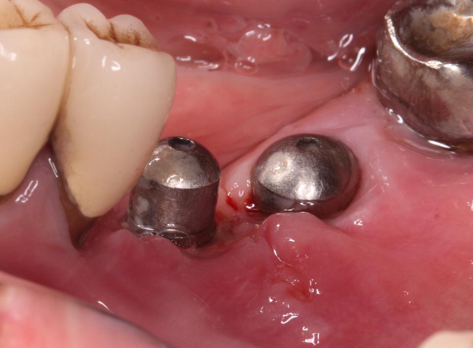 Fig. 2i: Subsequent follow-up at 2 weeks post-surgery