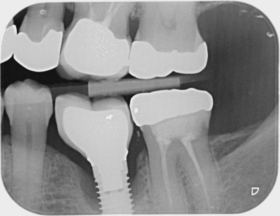 図5b: インプラント部位36の進行した骨吸収。患者は6年間、インプラント周囲支持療法を受けていない。インプラント周囲炎と進行性の骨吸収が認められ、咬翼法X線写真ではスレッド7の位置まで骨吸収が進行している。