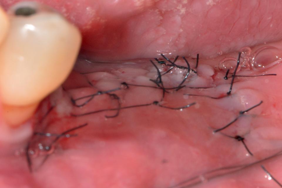 Fig. 4f: The surgical site achieved primary wound closure with the submerging of the implants