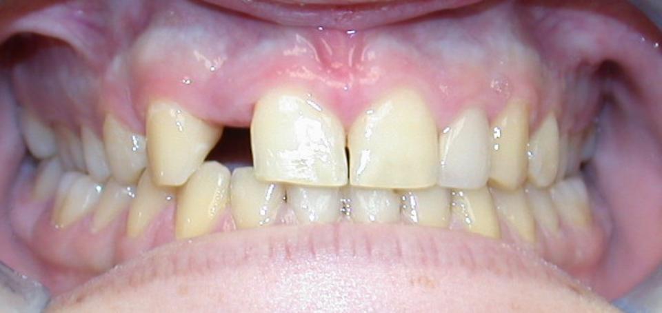 Şekil 1: Ortodontik tedavi sonrası sağ üst lateral kesici dişin restorasyonu için açılan yeri gösteren klinik fotoğraf. 