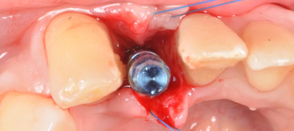 Fig. 10e: The effectiveness of narrow diameter implants relies on the adequate adjustment of occlusion to minimize biomechanical overloading. These can be considered a predictable minimally invasive alternative to preserve the critical buccal bone wall thickness