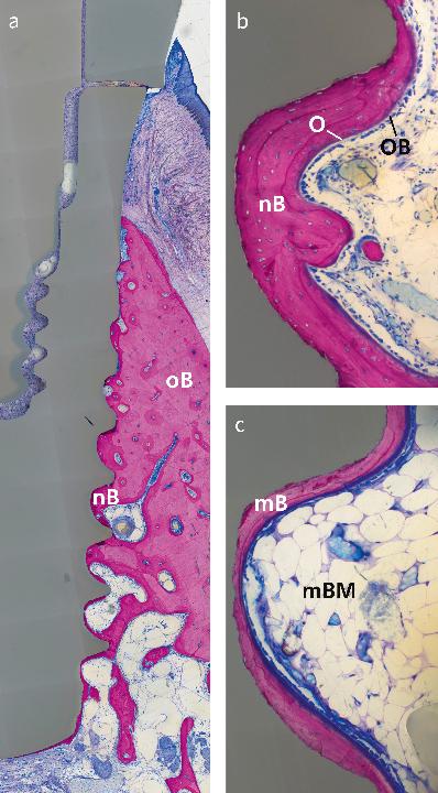 Fig. 24: Osseointegrated zirconia implants with ZLA® surface treatment after 4 (a, b) and 16 (c) weeks of loading. A thick layer of newly formed bone (nB), osteoid (O), and osteoblasts (OB) is visible after 4 weeks of loading, whereas mature bone (mB) and bone marrow (mBM) indicate full maturation after 16 weeks (from Janner et al. 2018 with permission)