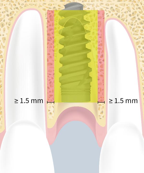 Fig. 4b: Posizione tridimensionale ideale dell'impianto – la spalla dell'impianto dovrebbe avere una distanza minima di 1,5 mm dai denti adiacenti e 3 mm tra gli impianti (riprodotto con l'autorizzazione di Lambert et al. 2023)