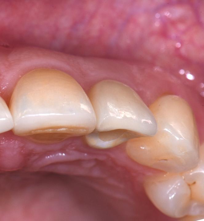 Fig. 2o: Occlusal view of the implant 2 years after implant placement