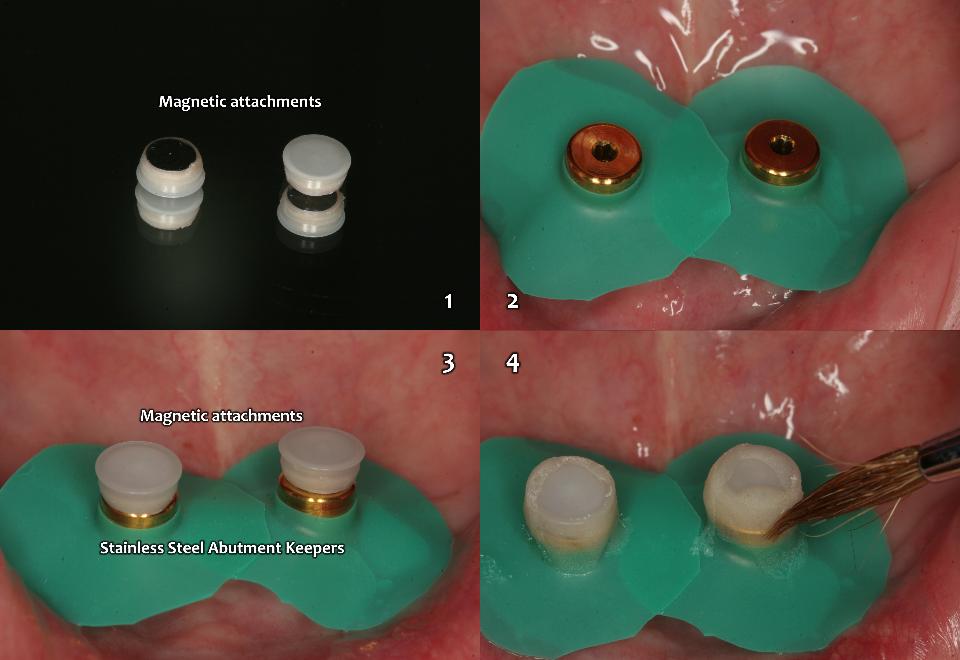 Fig. 15e: Preparation of 2-implant magnetic overdenture for the lower edentulous jaw. 1: the flexible type of magnetic attachment (Magfit-SX800, Aiichi Steel); 2: insert abutment keepers to the implants with 25Ncm fastening torque, and place the rubber dam block out; 3: place the magnetic attachments on the abutment keepers; and 4: initial coating the combination of magnetic devices (3) with self-curing acrylic resin