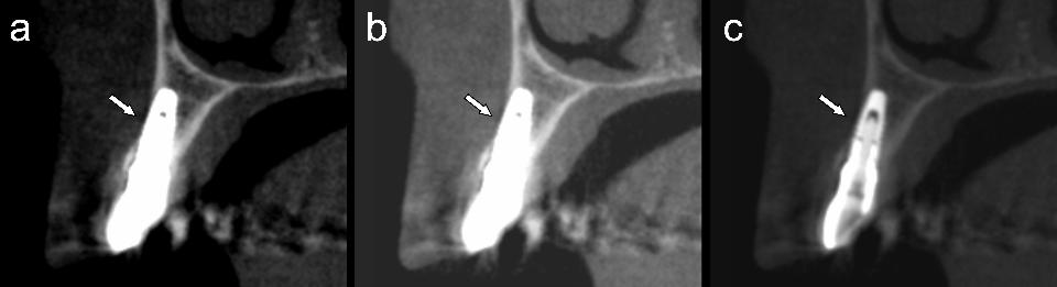 Fig. 4: Coupe transversale d’un implant dentaire en tomographie à faisceau conique à petit champ, révélant un artefact de blooming à trois niveaux d’échelle de gris : original (a), luminosité accrue (b) et contraste réduit (c). Les flèches blanches indiquent une région dans laquelle une fenestration est suspectée. Du fait de la nature mince de la lame corticale buccale, l’influence potentielle d’un artefact de volume partiel doit aussi être prise en compte. Avec l’aimable autorisation du Pr Sergio Lins de Azevedo Vaz.