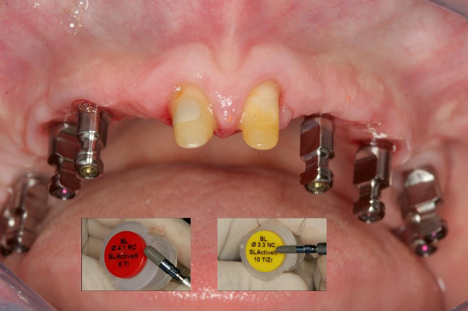 Fig. 6b: 2 upper central incisors were prepared for the full jacket crowns and 8 implants placed on the upper edentulous ridge for the fixed restorations. 2 Straumann Narrow Diameter implants (BL, 3.3x10, NC, Roxolid, SLActive, Straumann, Switzerland) for both upper canine sites without any bone enhancement procedures, 2 Straumann implants (BL, 4.1x10, RC, Ti, SLActive, Straumann) for both upper premolar sites, and 4 Straumann implants (BL, 4.1x8.0, RC, Ti, SLActive, Straumann) for both upper molar sites were selected in this case