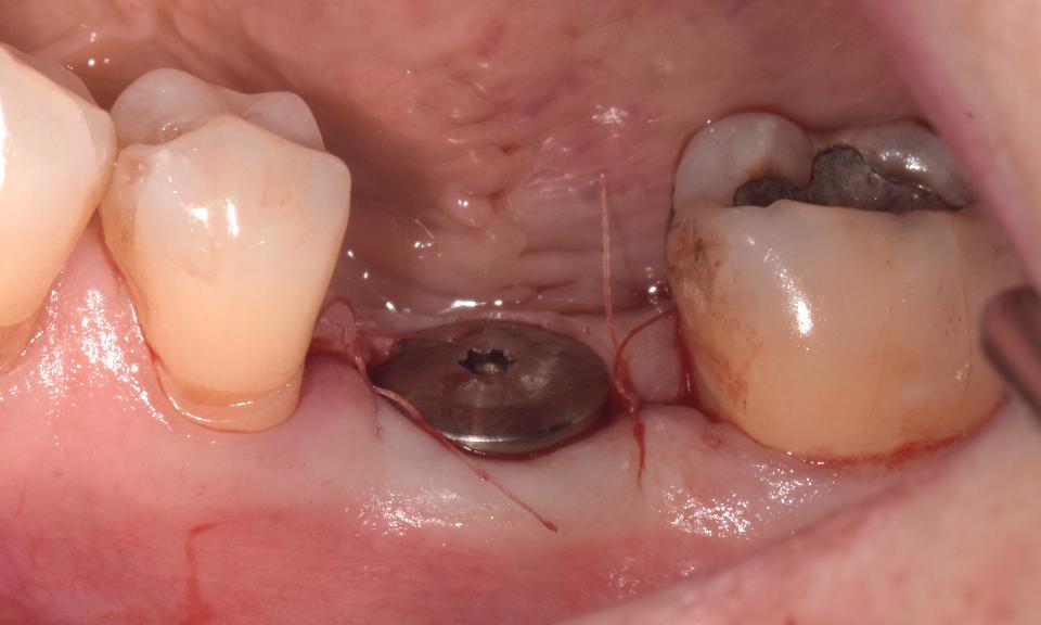 Fig. 3: Vue buccale du pilier de cicatrisation après la pose d'un implant simple sur le site d'une première molaire inférieure gauche.