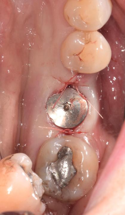 Fig. 2: Vue occlusale du pilier de cicatrisation après la pose d'un implant simple sur le site d'une première molaire inférieure gauche.