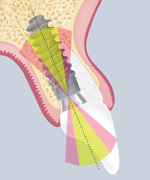 Fig. 4c: Posizione tridimensionale ideale dell'impianto – l'asse lungo dell'impianto dovrebbe essere posizionato attraverso il cingolo o la fossa centrale o il posizionamento del bordo incisale del restauro definitivo (riprodotto con il permesso di Lambert et al. 2023)