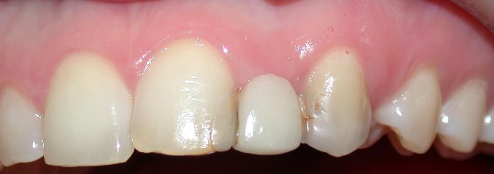 図5: 先天欠損の右側上顎側切歯を補うために長年使用した接着ブリッジの臨床写真。臨床写真では、補綴のための十分なスペースが確保されているように見える