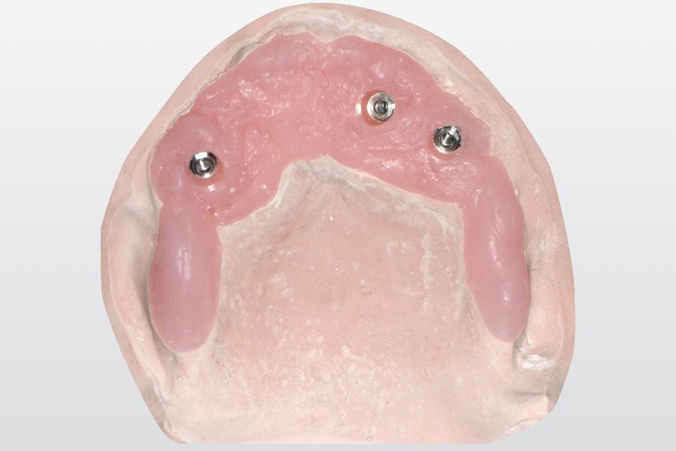 Fig. 11: A dental stone cast can be digitalized with a laboratory scanner for the subsequent CAD/CAM prosthesis fabrication